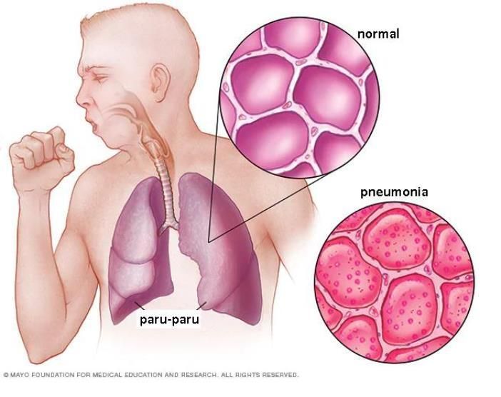 Gejala, Penyebab, dan Cara Mengobati Pneumonia